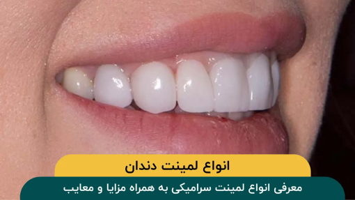 انواع-لمینت-دندان